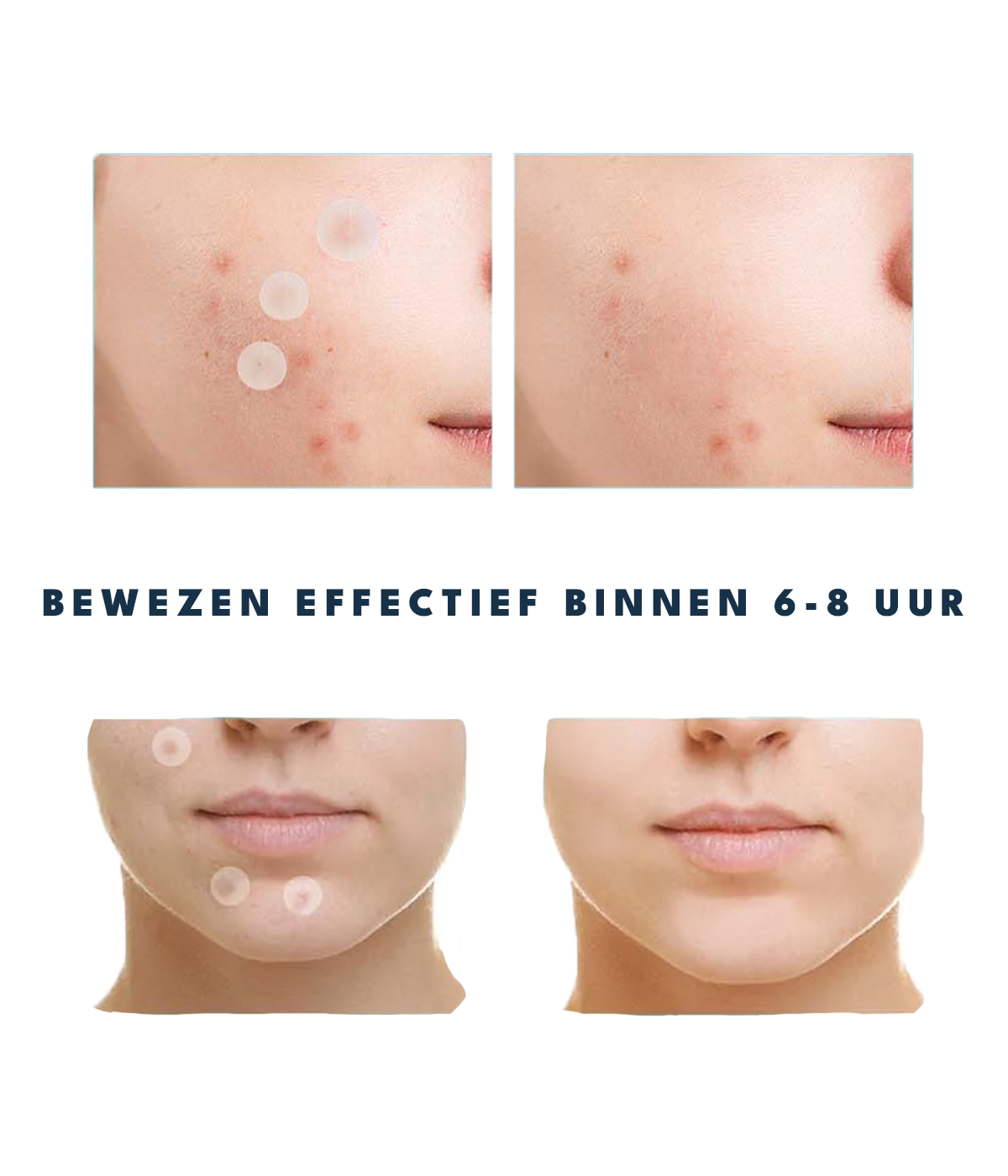 Pimple Patches - Onzuiverheden Stickers